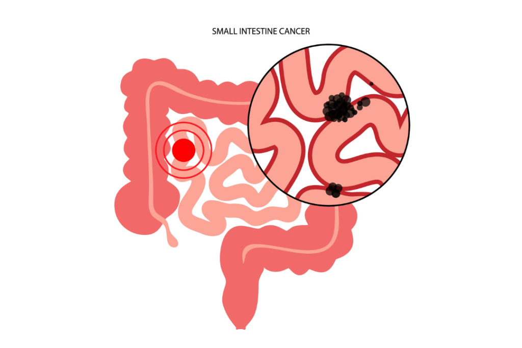 Όγκοι λεπτού εντέρου