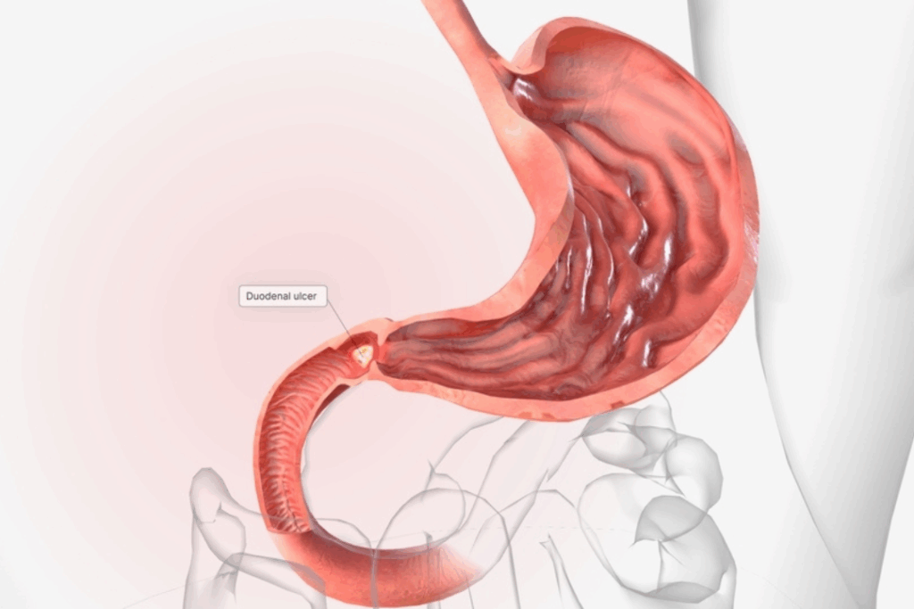 έλκος δωδεκαδακτύλου
